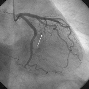 Coronary angiography in RAO projection illustrating only partial and filiform filling of 1st MB. Note the absence of disease in the remaining vessels. RAO=right anterior oblique; MB=marginal branch.