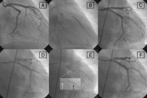 Angioplasty sequence in RAO. (A) Filiform filling of 1st MB; (B) distal stent deployment; (C) angio post distal stent; (D) proximal stent deployment; (E) stents correctly positioned from the ostium of the 1st MB (white arrow in zoom) with 1mm overlapping (black arrow in zoom) between them; and (F) final result without retrieving the wire.