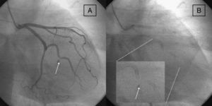 Post stenting angiography in RAO projection after removing the guidewire. (A) Note the dissection in the mid portion of the artery (white arrow). (B) Note the gap between the previously overlapped stents (white arrow in zoom). RAO=right anterior oblique.