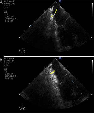 Edema formation at the cavo-tricuspid isthmus. (A) baseline thickness of the cavo-tricuspid isthmus (yellow line) and cross-sectional view of a multipolar catheter positioned around the tricuspid annulus (yellow arrow). (B) significant increase in thickness at the cavo-tricuspid isthmus after radiofrequency delivery (yellow line).