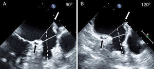 Transesophageal Evaluation of the LAA. The LAA is assessed in multiple TEE views (examples, panel A: 90°, panel B: 120°; see Methods section for details). The diameter (broken white line) of the LAA-O is measured from the proximal aspect of the origin of the circumflex artery (black arrow) to the tip of the ligament of Marshall (white arrow). The diameter (solid white line) of the LAA at a depth of 10mm from the ostium representing the lobe landing zone (LAA-L), and the LAA depth (broken white line) are also measured. LAA, left atrial appendage; LAA-L, left atrial appendage at 10mm depth from ostium; LAA-O, left atrial appendage at ostium; TEE, transesophageal echocardiography.