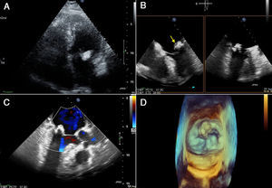 (A) Transthoracic echocardiogram showing a 2.5cm×1.5cm echolucent, crescent-shaped, semilunar mass in the posterior mitral annulus. Caseous calcification of the mitral valve was diagnosed. (B) Transesophageal echocardiogram showing mobile images attached to the mitral annulus (arrow). (C) Transesophageal echocardiogram color Doppler without mitral regurgitation. (D) 3D images showing the CC of the annulus and the vegetations. Differential diagnosis with an abscess was fundamental as treatment would have been completely different (medical treatment vs. surgery).