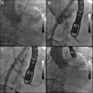 Transcatheter aortic valve implantation.