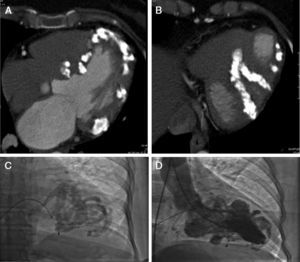 Heart CT scan showing four chambers at the papillary muscle level and the presence of calcium infiltrating the myocardium (A). And seen from the inferior wall of the left ventricle, myocardial calcium infiltration is evident (B). Cardiac catheterization showed extensive calcification distributed in bands and with the respected areas (calcium free) protruding between the calcium bands during ventricular diastole (C and D).