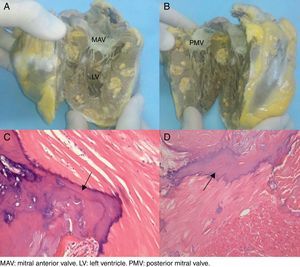 Macroscopic images of the explanted heart in a coronal section showing multiple intra-myocardial calcifications (A and B). Microphotographs (10× and 40×, respectively) of Hematoxylin and Eosin staining (C and D). (C) A bony spicule (arrow) replaces residual cardiac muscle. (D) A laminated spicule (arrow) is seen on the left and residual cardiac muscle on the right.