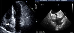 Izquierda: ecocardiograma transtorácico mostrando plano apical de 4 cámaras. Flecha: septo interauricular. Derecha: ecocardiograma transesofágico 2D, visualizándose el septo interauricular desde el plano bicava.