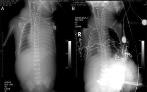 A)Canulación venosa y arterial en el primer paciente sometido a soporte ECMO con hernia diafragmática izquierda. B)Posquirúrgico de corrección del defecto diafragmático. 40-4.