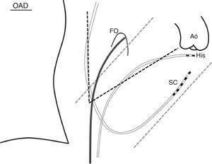 Esquema en proyección oblicua anterior derecha (OAD) del perfil derecho de la porción superior del corazón. En la imagen queda claro cómo el electrodo que sirve para registrar el electrograma del haz de His (His) se encuentra justo por debajo de la válvula aórtica. En líneas se representa el catéter del seno coronario (SC). La línea oscura ligeramente curva representa el «sistema» de la funda de Mullins con el dilatador y la aguja de Brockenbrough apoyado sobre el foramen oval (FO).