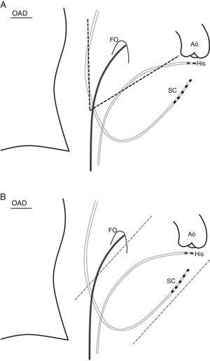 A)El mismo esquema que la figura 1, donde se señala que la punta del «sistema» (línea negra) debe estar paralela al catéter del seno coronario (SC), señalado por las 2líneas punteadas. B)En el mismo esquema, se subraya que la punta del «sistema» debe ser la mediatriz del ángulo que forman el cuerpo del catéter del seno coronario, que está en la aurícula derecha, y el catéter del haz de His.