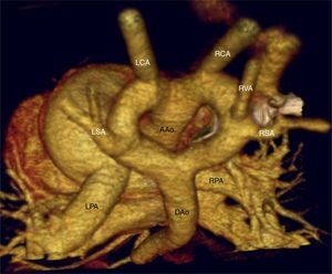 Angio-TC torácica con reconstrucción VR-3D, visión posterosuperior. En esta imagen podemos observar un arco aórtico completo, con origen independiente de los troncos supraaórticos: en el arco izquierdo, ligeramente de mayor calibre, se originan la arteria carótida y subclavia izquierdas y en el arco derecho, la arteria carótida, vertebral y subclavia derechas. AAo: ascending aorta (aorta ascendente); DAo: descending aorta (aorta descendente); LCA: left carotid artery (arteria carótida izquierda); LPA: left pulmonary artery (arteria pulmonar izquierda); LSA: left subclavian artery (arteria subclavia izquierda); RCA: right carotid artery (arteria carótida derecha); RPA: right pulmonary artery (arteria pulmonar derecha); RSA: right subclavian artery (arteria subclavia derecha); RVA: right vertebral artery (arteria vertebral izquierda).