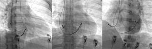 Projections of RAO, PA and LAO in one patient with three catheters, a radial artery approach and two subclavian right punctures. RAO, right anterioroblique; PA, posteroanterior; LAO, left anterior oblique.