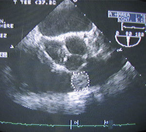 Ecocardiograma. Se aprecia una masa de 2cm de diámetro en tracto de salida del ventrículo derecho, además de observarse la válvula aórtica y la arteria pulmonar.
