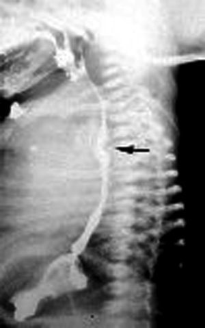 Placa lateral de Rx. Paciente con deleción 22q11.2, en el que durante el trago de bario se observa en la parte posterior del esófago una muesca (flecha), producto de la compresión extrínseca por arteria subclavia derecha aberrante.