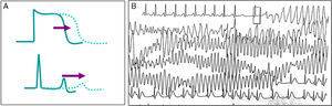 A. Representación esquemática de la prolongación del potencial de acción que se traduce en prolongación del intervalo QT en el electrocardiograma. B. Episodio de taquicardia ventricular polimorfa autolimitado en una paciente con historia de síncope y síndrome de QT largo.