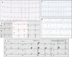 Trazos electrocardiográficos representantivos de: A. Síndrome de QT corto; B. Síndrome de Brugada. A la izquierda el ECG tipo I, en medio tipo II y a la derecha tipo III; C. Trazo basal en reposo de un paciente con TVPC; D. Trazo del mismo paciente C, al esfuerzo que muestra múltiples extrasístoles polimórficas; E. Paciente de 18 años con fibrilación ventricular y repolarización precoz. Corazón estructuralmente normal. Las flechas indican elevación del punto J, u «onda J».