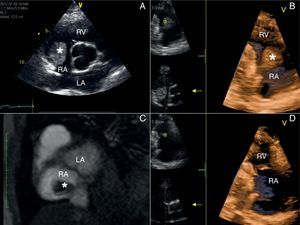 (A) Two-dimensional echocardiography: parasternal short axis view showing a mass (asterisk) on the posterior wall of the right atrium (RA). (B) Three-dimensional echocardiography: right ventricle (RV) inflow tract view displaying a round shaped mass (asterisk) with a stalk attached to the posterior wall of the RA. (C) Delayed-enhancement cardiovascular magnetic resonance demonstrating the lack of gadolinium contrast uptake (asterisk) as the thombus is avascular. (D) Three-dimensional echocardiography: normal RV inflow tract view without evidence of thrombus after sixth months of anticoagulation therapy. LA: left atrium.