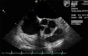 Ecocardiograma transesofágico de la aorta a 36° que muestra la válvula aórtica cuatricúspide en diástole.