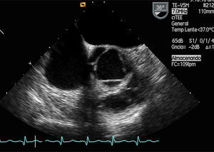 Ecocardiograma transesofágico de la aorta a 36°, que muestra una válvula aórtica cuatricúspide que evolucionó a tricúspide por fusión de 2 sigmoideas adyacentes.