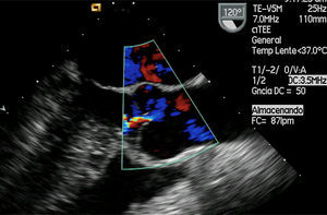 Ecocardiograma transesofágico registrado a 120°, que muestra la aorta en el plano longitudinal. Se observa un chorro («jet») de regurgitación aórtica leve central.