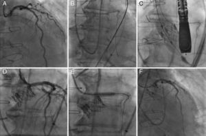 Left coronary artery (LCA) angiography before deployment of the transcatheter valve (A). LCA protection with an extra-support Wiggle guidewire™ (B). Image showing the deployment of the transcatheter valve (C). Angiography showing partial ostial obstruction of the LCA after the transcatheter valve implantation (D). Pre-dilatation of the left main coronary artery with a 4.0×12mm balloon (E). Final angiography after the successful deployment of a drug-eluting stent into the ostium of the left main coronary artery (F).