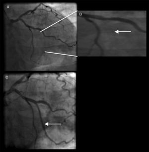 A-B) Angiografía coronaria en donde se muestra la oclusión total del stent en la arteria circunfleja (flecha blanca). C) Angiografìa coronaria posterior a la angioplastia primaria en donde se observa (flecha blanca) la restitución del flujo en el ramo marginal.