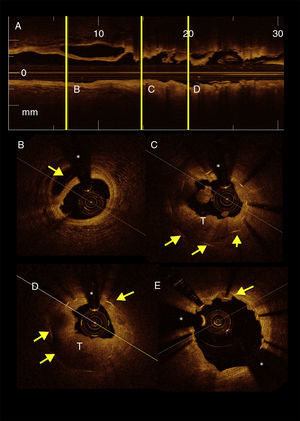 A) Imagen del corte horizontal de tomografía de coherencia óptica (TCO) de la arteria circunfleja. B) Imagen de TCO en donde se observa el borde distal del stent, en un segmento de arteria sana, en la que se observa la disección coronaria (flecha amarilla). C-D) TCO en donde se observan los soportes del stent (flechas amarillas) y la abundante cantidad de trombo intrastent (T). E) TCO en donde se observa el estado final de la arteria circunfleja, posterior a la aspiración de trombo y angioplastia con balón. Se observan los soportes del stent aún con pequeña cantidad de trombo (flechas amarillas). (*) Guía intracoronaria.