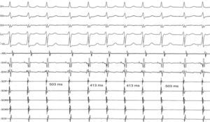 Registro electrocardiográfico e intracavitario que muestra la secuencia de agrupamiento de cuatro complejos QRS separados por intervalos del ciclo más prolongados. Adviértase que los intervalos AH más breves son idénticos, 413ms) y que los intervalos más prolongados también lo son. Estos no están precedidos por ningún cambio que preanuncie su aparición. EHH d: haz de His distal; EHH p: haz de His proximal; SCD: seno coronario distal; SCM: seno coronario medio; SCP: seno coronario proximal.