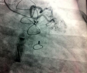 Conexión anómala con origen en tronco de la pulmonar por coronariografía.