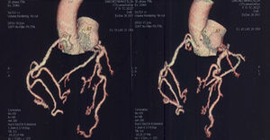 Conexión anómala con origen en tronco de la pulmonar por angiotomografía.