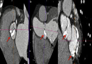 a y b) Calcificación de la comisura y cuerpo de las valvas coronaria derecha y no coronaria. c) Calcificación grave de la válvula aórtica y del anillo mitral. Las flechas señalan las zonas de calcificación descritas.