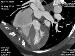 Fístula entre raíz de aorta y aurícula derecha en paciente con endocarditis infecciosa (flecha). El estudio confirmó la complicación que ya era evidente en el ecocardiograma transesofágico y permitió la valoración de las coronarias antes de la cirugía.