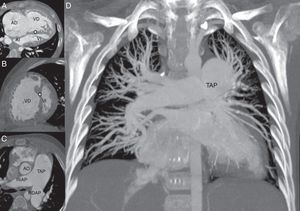 Angiotomografía de arterias pulmonares. Se observa dilatación importante de la aurícula (AD) y ventrículo derecho (VD) así como incremento en la trabeculación de su pared y mayor tamaño que el ventrículo izquierdo; señalados en la imagen A. También se muestra el septum interventricular plano (asterisco) condicionando imagen en «D» del VI (ventrículo izquierdo) señalados en la imagen A y B. Obsérvese en la imagen C la importante dilatación del tronco de la arteria pulmonar (TAP), así como de su rama principal izquierda (RIAP) y de la derecha (RDAP) al compararlos con la aorta ascendente (AO). En la imagen D se muestran el tronco y las ramas pulmonares hasta los segmentos distales en ambos hemitórax en donde no se observaron defectos de llenado.