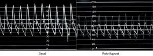 Determinación de vasorreactividad en un paciente con comunicación interventricular h hipertensión pulmonar grave mediante manejo farmacológico con iloprost. (Cortesía del Dr. José A. García Montes).