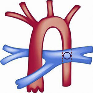 Fístula sistémico-pulmonar de Potts.