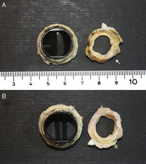 Imagen de la prótesis aórtica desde ambas facetas: arterial (A) y ventricular (B). El tejido de pannus (flecha) se extiende alrededor de la circunferencia, siendo visible la considerable reducción del diámetro en el orificio valvular efectivo de la prótesis valvular aórtica.