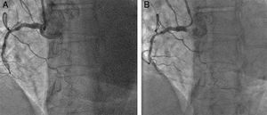 (A) The lack of guide catheter support was the cause of the failure to advance the guidewire and cross the chronic total occlusion (CTO). (B) A Guideliner catheter was advanced and a Pilot 150 wire crossed the CTO.