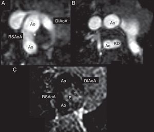 CMR of the aorta. SSFP fixed cine image axial view at aortic arch level and just distal (A) shown a double incomplete aortic arch with right-sided aorta and a KD (B). An axial T2-W image showed compression of the trachea (T) and the esophagus (E) by vascular structures (C). CMR, cardiac magnetic resonance; SSFP, steady state free precession; T2-W, T2-weighted; CE-MRA, contrast-enhanced magnetic resonance angiography; MIP, maximum intensity projection; 3D VR, 3-dimensional volume rendering; Ao, aorta; DIAoA, double incomplete aortic arch; RSAoA, right sided aortic arch; ALSA, aberrant left subclavian artery; KD, Kommerell's Diverticulum.