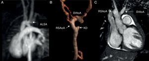 CMR of the aorta. ALSA originates from the incomplete left aortic arch as shown in the CE-MRA on MIP (A) and 3D VR reconstructions (B). The KD originating from the descending aorta is shown in (B). A coronal SSFP view shows “V” shape of the double incomplete aortic arch (C). CMR, cardiac magnetic resonance; SSFP, steady state free precession; T2-W, T2-weighted; CE-MRA, contrast-enhanced magnetic resonance angiography; MIP, maximum intensity projection; 3D VR, 3-dimensional volume rendering; Ao, aorta; DIAoA, double incomplete aortic arch; RSAoA, right sided aortic arch; ALSA, aberrant left subclavian artery; KD, Kommerell's Diverticulum.