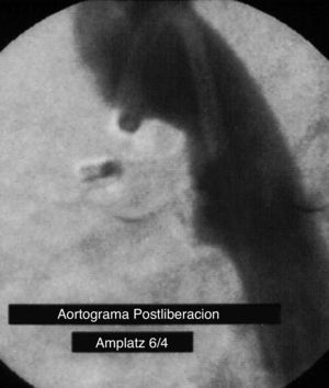 Aortografía postimplante del dispositivo Amplatzer Duct Occluder 6/4mm, posicionado completamente dentro del conducto arterioso y sin flujo residual.