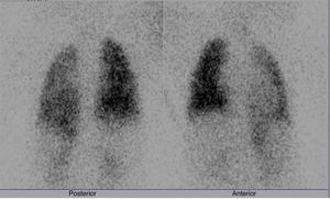 Gammagrafía pulmonar de perfusión con 99mTc-MAA en un paciente con disminución en la perfusión izquierda, posterior al implante del Amplatzer Duct Occluder.