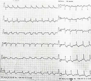 Electrocardiograma registrado durante el primer contacto médico.