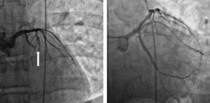 Oclusión trombótica de la arteria circunfleja proximal (flecha) y resultado angiográfico final tras la angioplastia.