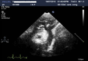 Observed in bi-dimensional echocardiography, suprasternal window numerous vegetations located in aortic root and supra-aortic arteries.