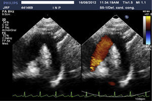 Bidimensional echocardiography in suprasternal view post-treatment without vegetations in the aortic root.