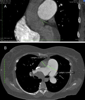 Imagen de tomografi¿a computarizada multicorte en la que se muestra el desplazamiento inferior del tronco sobre el seno de Valsalva izquierdo (A), y la dilatación de la arteria pulmonar en comparación a la aorta (B).