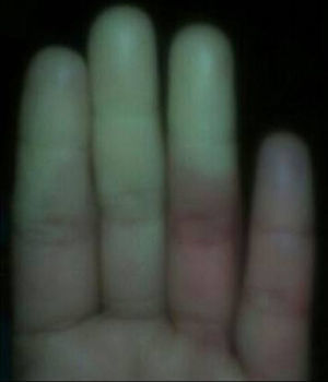 Imagen de la mano de la paciente, en la que se aprecia una tonalidad blanca de las falanges distales, típica de vasoespasmo.