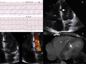 (A) Surface ECG showing a complete right bundle branch block. (B) Echocardiography (apical 4 chambers view) displaying an incomplete rupture of the interventricular septum (arrow) at the left side. (C) Zoomed 2D and color Doppler imaging views disclosing no shunt between the left ventricle (LV) and the right ventricle (RV). (D) Close view of the heart on chest CT scan revealing an interventricular septum tearing (arrow) noticed in a second review of the scan.