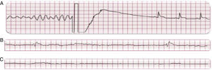 En A: Fibrilación ventricular y desfibrilación exitosa en un paciente con infarto agudo de miocardio y paro cardiaco súbito. En B y C: Ritmo agónico y asistolia en un paciente con insuficiencia cardiaca y paro cardiaco súbito.