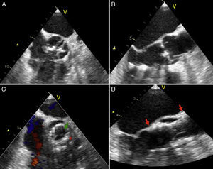 Ecocardiografía transesofágica, A y B. Eje corto y eje largo de un paciente con válvula aórtica bicúspide; C. Eje corto del ETE después del TAVI, la flecha verde señala las valvas de la prótesis y el asterisco rojo la parte metálica (stent de nitinol); D. Eje longitudinal después de la implantación, las flechas rojas señalan la longitud de la válvula.