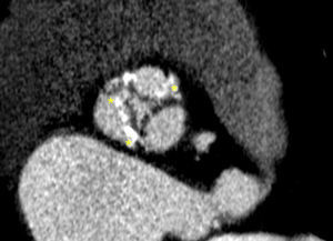 Ejemplo de un paciente favorable para implantación sin predilatar. Como puede observarse en el TCMD en eje corto la calcificación es escasa, está distribuida de forma homogénea en las 3 valvas (asteriscos) y la apertura valvular es central